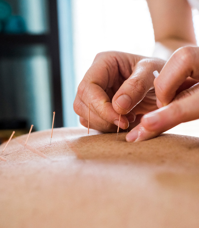 Akupunktur